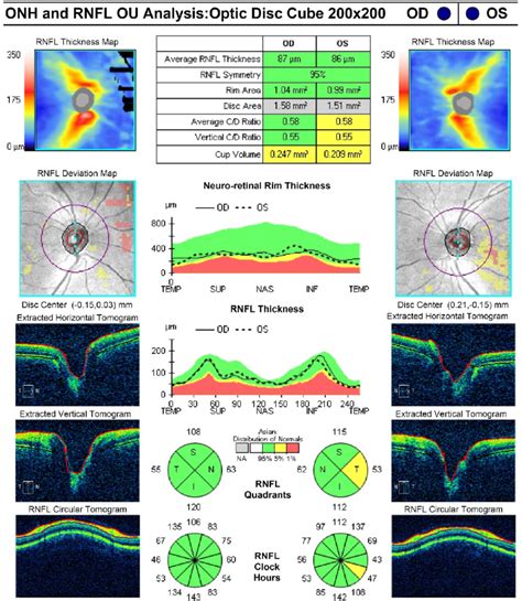 optic nerve thickness measurement radiology|average rnfl thickness by age.